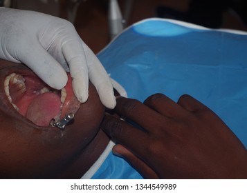 Decayed teeth being fixed by a dentist 