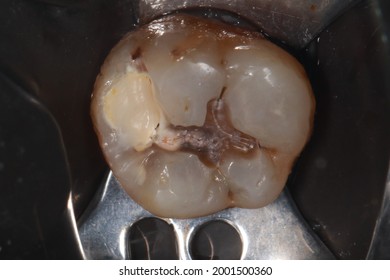 2,941 Cement tooth Images, Stock Photos & Vectors | Shutterstock