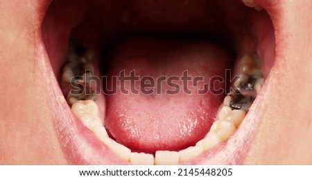 Decayed tooth root canal treatment. Tooth or teeth decay of lower molar. Restoration with a composite filling. Adult caries. bad teeth. Dental temporary restorative material. Dental concept. close up.