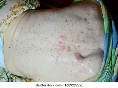 Decubitus Ulcer. Pressure Ulcers On Skin Tissue. The Increased Pressure Prevents The Blood From Circulating Properly, And Causes Cell Death, Tissue Necrosis And The Development Of Pressure Ulcers