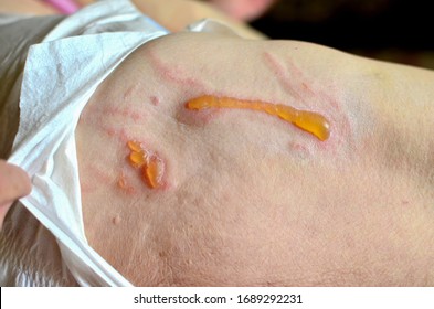 Decubitus Ulcer. Pressure Ulcers On Skin Tissue. The Increased Pressure Prevents The Blood From Circulating Properly, And Causes Cell Death, Tissue Necrosis And The Development Of Pressure Ulcers