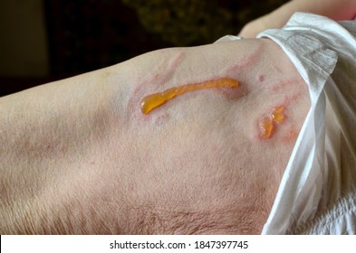 Decubitus Ulcer. Pressure Ulcers On Skin Tissue. The Increased Pressure Prevents The Blood From Circulating Properly, And Causes Cell Death, Tissue Necrosis And The Development Of Pressure Ulcers