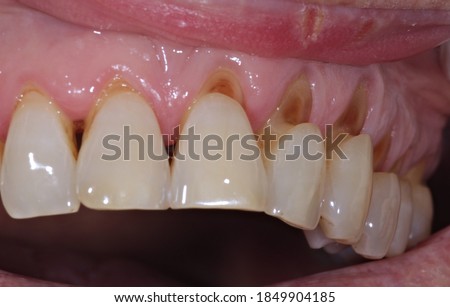 
Deep brushing abrasions. Too vigorous brushing, with an incorrect technique, initially causes gingival recessions, and subsequently the abrasion of the exposed root surfaces.