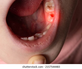 Deep Caries In Children On Milk Teeth. Treatment Of Caries, Toothache. Macro