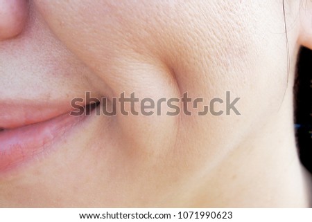 Deep Dimple on Asian Woman Cheek with Wide Pores Skin