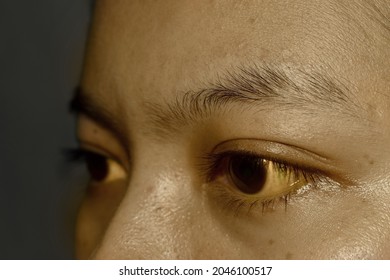 Deep jaundice in Asian female patient. Yellowish discoloration of skin and sclera. Hyperbilirubinemia. Acute hepatitis. - Shutterstock ID 2046100517