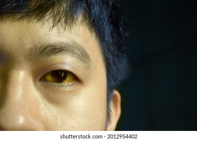 Deep Jaundice In Asian Male Patient. Yellowish Discoloration Of Skin And Sclera. Hyperbilirubinemia. Acute Hepatitis.