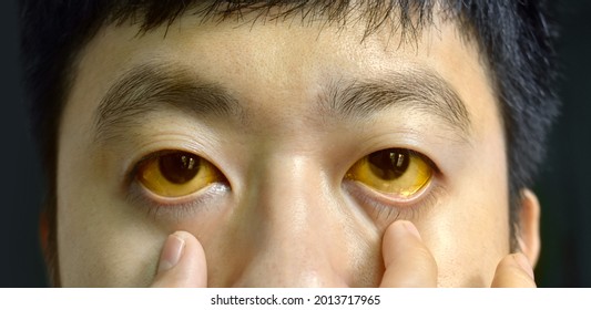 Deep Jaundice In Asian Male Patient. Yellowish Discoloration Of Skin And Sclera. Hyperbilirubinemia. Acute Hepatitis.