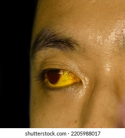 Deep Jaundice In Asian Male Patient. Yellowish Discoloration Of Skin And Sclera. Hyperbilirubinemia. Acute Hepatitis.