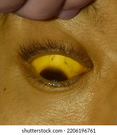 Deep Jaundice In Asian Male Patient. Yellowish Discoloration Of Skin And Sclera. Hyperbilirubinemia. Acute Hepatitis.