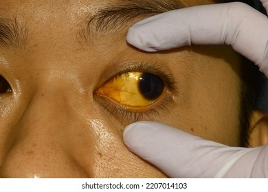 Deep Jaundice In Asian Male Patient. Yellowish Discoloration Of Skin And Sclera. Hyperbilirubinemia. Acute Hepatitis.