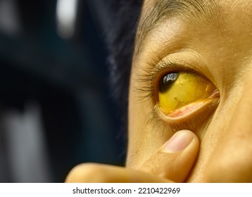 Deep Jaundice In Asian Male Patient. Yellowish Discoloration Of Skin And Sclera. Hyperbilirubinemia. Acute Hepatitis.