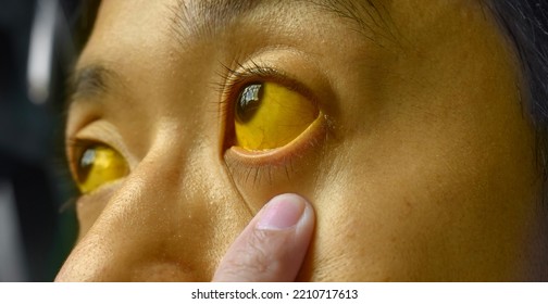 Deep Jaundice In Asian Male Patient. Yellowish Discoloration Of Skin And Sclera. Hyperbilirubinemia. Acute Hepatitis.