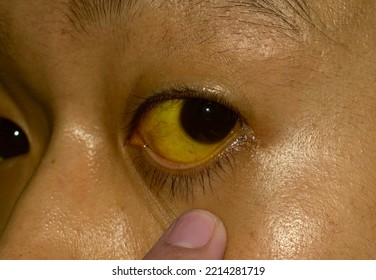 Deep Jaundice In Asian Male Patient. Yellowish Discoloration Of Skin And Sclera. Hyperbilirubinemia. Acute Hepatitis.