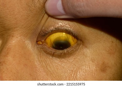 Deep Jaundice In Asian Male Patient. Yellowish Discoloration Of Skin And Sclera. Hyperbilirubinemia. Acute Hepatitis.