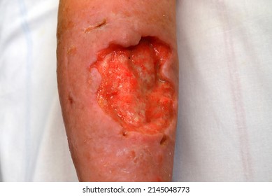 Deep Large Trophic Ulcer On Leg, Wound, Defect Of Skin And Soft Tissues. Complications Of Varicose Veins Of Lower Leg, Weeping Trophic Wound, Eczema, Dermatitis. Severe Medical Illness