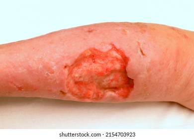 Deep Large Trophic Ulcer On Leg, Defect Of Skin And Soft Tissues. Complications Of Varicose Veins Of Lower Leg, Weeping Trophic Wound, Eczema, Dermatitis. Severe Medical Illness