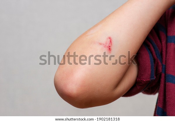 Deep scratches on the skin with bruises on the childs\
hand. Wounds, scratches, abrasions on the childs hand, elbow close\
up.