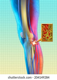 Deep Vein Thrombosis