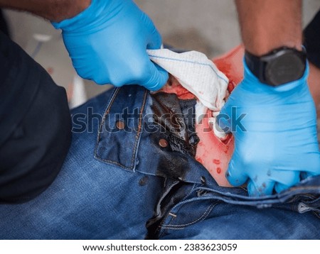 A deep wound on the leg is treated professionally. For this purpose, the paramedic uses a hemostatic gauze.  The concept is called woundpacking and comes from tactical medicine. 