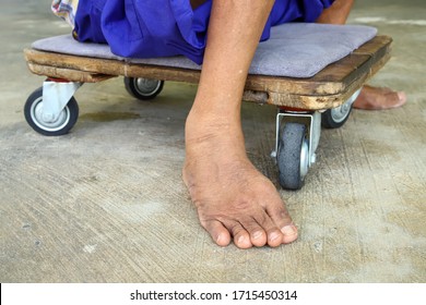 Deformed Legs Are Small Caused By Polio, There Is No Force, Must Have A Castor Board