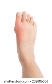 Deformed Right Big Toe With Painful Gout Inflammation.