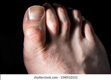 Deformity Of The Foot, Hammer Big Toe