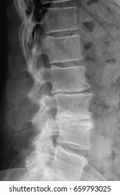 Degenerative Disc Disease