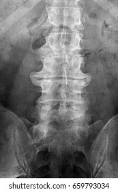 Degenerative Disc Disease