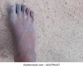 dry black feet