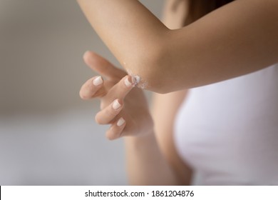 Delicate Softening. Close Up Of Millennial Female Applying Body Cream Balm On Rough Flaky Skin. Young Woman With Sensitive Skin Using Cosmetic Product First Time Trying It On Small Area Zone On Elbow