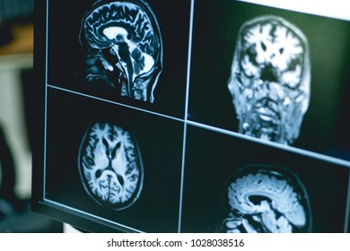 Dementia On MRI Film 