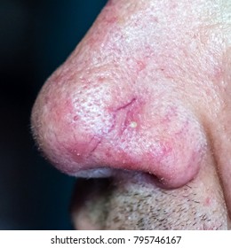 Demodecosis Of The Face. Reddened, Inflamed Skin. Pustular Eruptions. Manifestation Of Small Veins On The Surface.