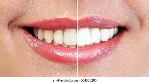 Demonstration Of Dental Whitening Result, Before And After Procedure. Dentistry Concept.