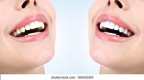 Demonstration Of Dental Whitening Result, Before And After Procedure. Dentistry Concept.