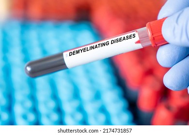 Demyelinating Diseases. Demyelinating Diseases Disease Blood Test Inmedical Laboratory