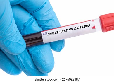 Demyelinating Diseases. Demyelinating Diseases Disease Blood Test In Doctor Hand