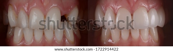Dental all ceramic\
bridge before and after. Dental bridge prosthetic at front teeth to\
replace missing teeth.