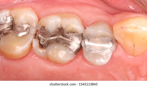 Dental Amalgam Dental Restoration Defective Filling