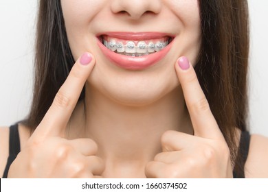 Dental braces in happy womans mouths who shows by two fingers on brackets on the teeth after whitening. Self-ligating brackets with metal ties and gray elastics or rubber bands for perfect smile