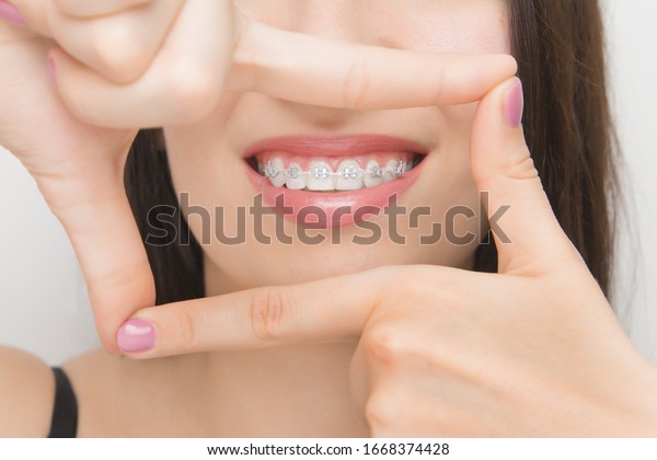 gray rubber bands braces