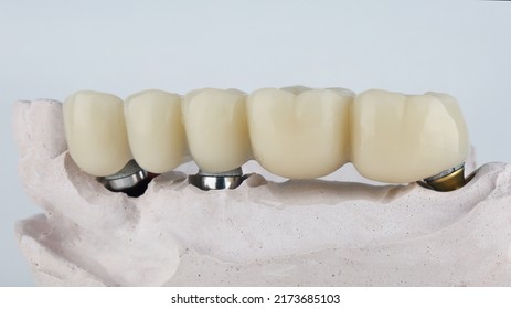 Dental Bridge Prosthesis Of Five Chewing Teeth On A Beam With A Model