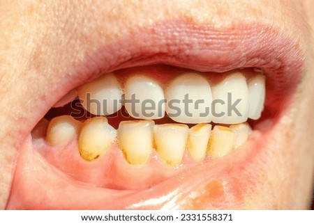 Dental calculus on teeth, sign of smoking habits. Bacterial plaque on smokers teeth