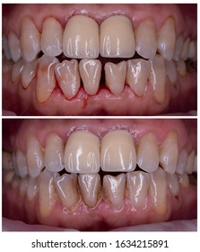 dental calculus removal cost
