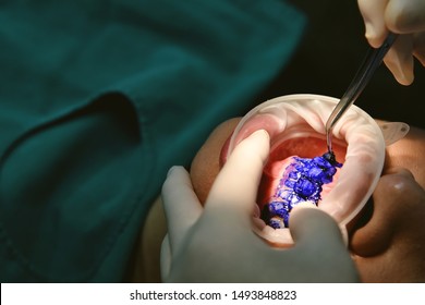 Dental Care Check Up, Dentist Examining And Doing Teeth Treatment In Dental Clinic, Plaque Disclosing, Color Dye To Spot The Bacteria Biofilm, Healthy Oral Hygienic.