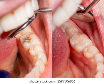 Dental caries. Filling with dental composite photopolymer material using Rubber Dam. The concept of dental treatment in a dental clinic