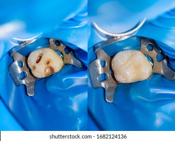 10,657 Composite dental Images, Stock Photos & Vectors | Shutterstock