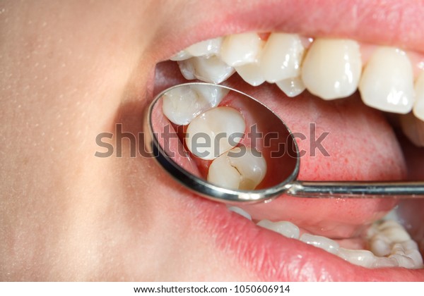 Dental caries. Filling with dental composite\
photopolymer material using rabbders. The concept of dental\
treatment in a dental\
clinic