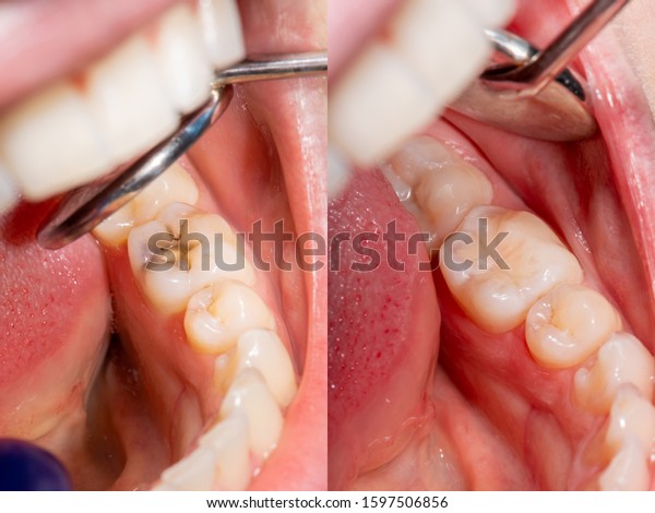 Dental caries. Filling with dental composite\
photopolymer material using Rubber Dam. The concept of dental\
treatment in a dental\
clinic