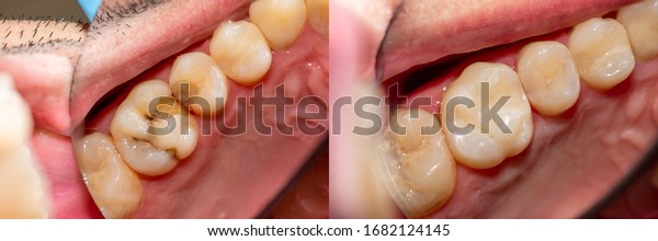Dental caries. Filling with dental composite
photopolymer material using rabbders. The concept of dental
treatment in dental
clinic